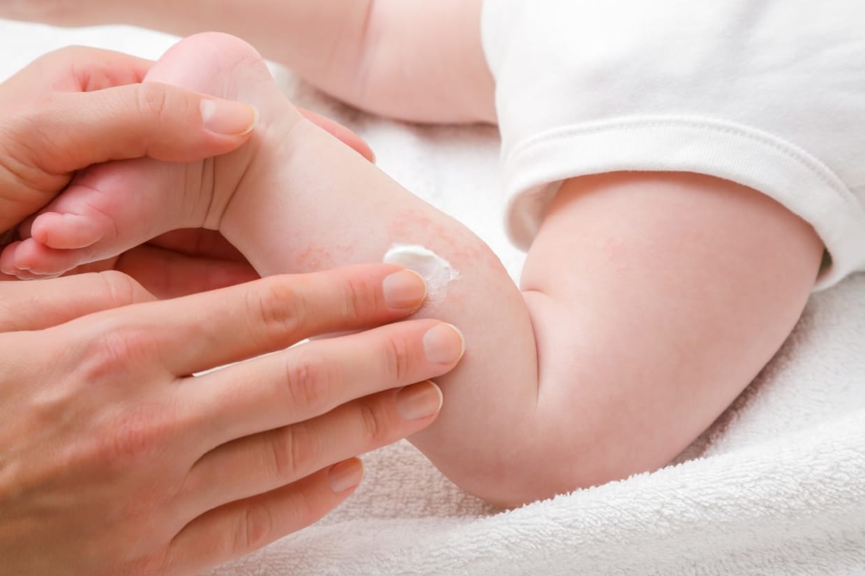 Nahrungsmittelunverträglichkeiten und -allergien im Säuglingsalter